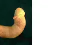 To fix a bent penis caused by Peyronies disease or, a congenital curvature (one you are born with), traction is the #1