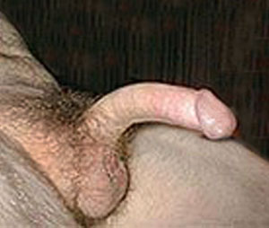 peyronies disease pictures #6 of 10