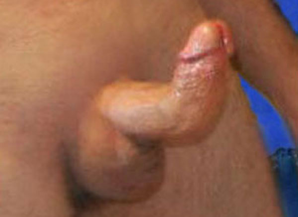 penis pain from peyronies disease