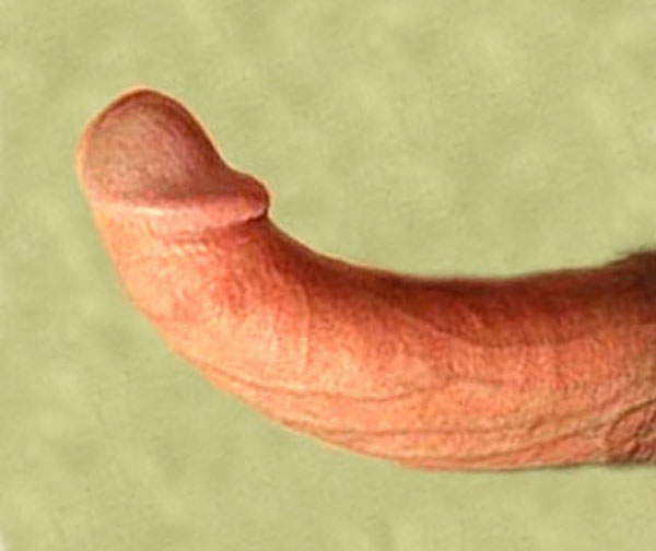 severe congenital curved penis