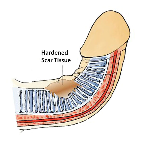 penis disease and a bent penis