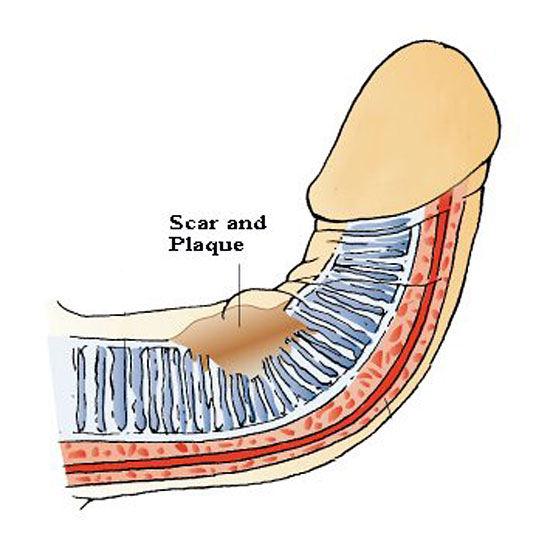 why peyronies is not a disease