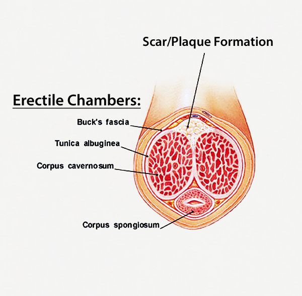 penis curvature from the erectile chambers and tunica albuginea