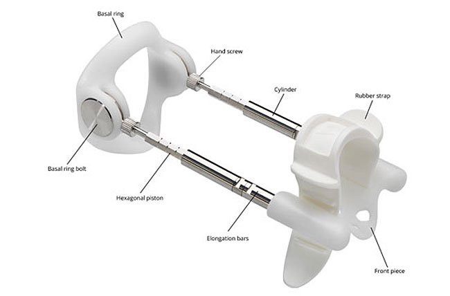 penis traction device for peyronies disease bent penis