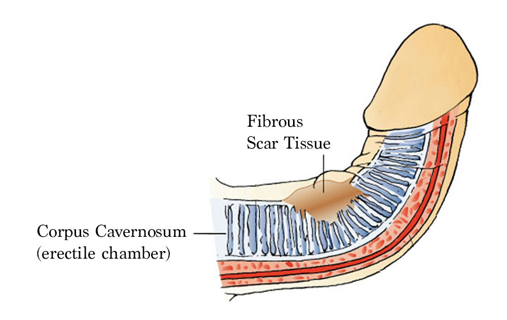 how to fix a curved penis caused by fibrous scar tissue