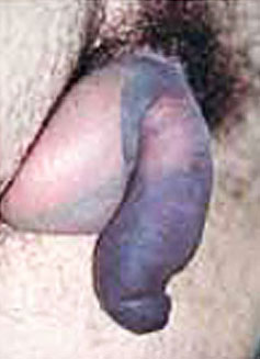 penile injury