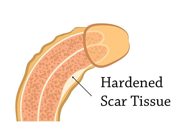 How to straighten a curved penis