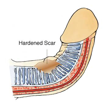 peyronies disease scar tissue that causes the bend