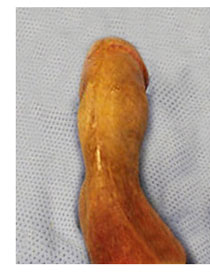 hourglass penis, peyronies disease