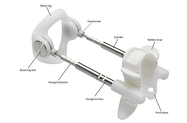 penis traction therapy (PTT) to straighten a penis