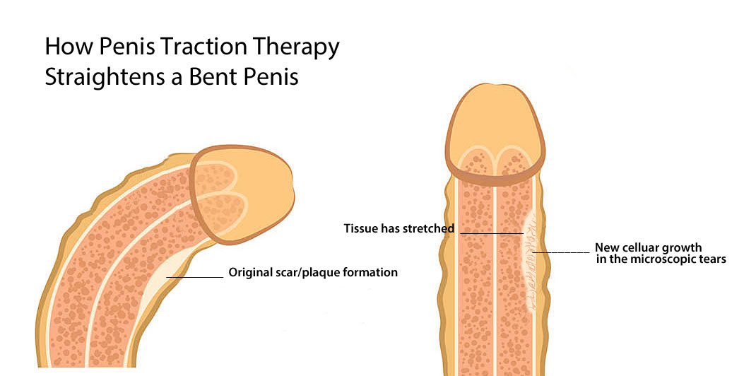 straightening a bent healthy penis