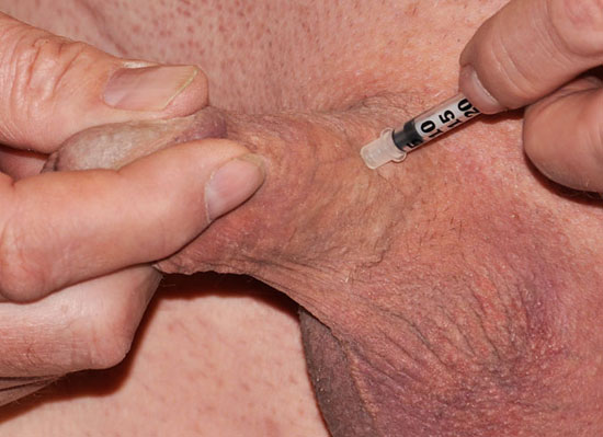 penis straightening with injection therapy