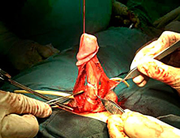 cirurgia do pénis curvado