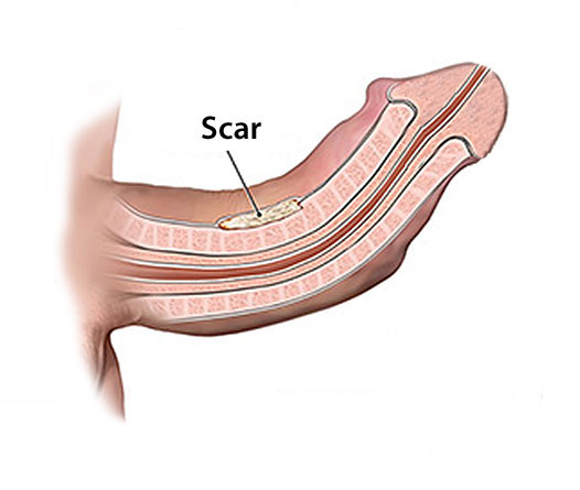 what is peyronies disease #2