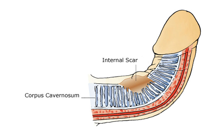 cosmetic penis surgery for a bent penis, peyronies disease