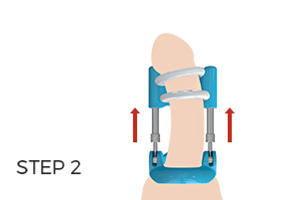 penis traction therapy vs penis pumps #2