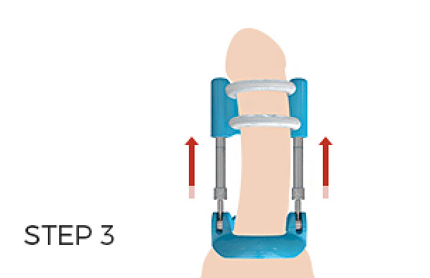 penis traction therapy vs penis pumps #3