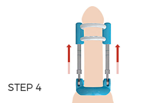 penis traction therapy vs penis pumps #4