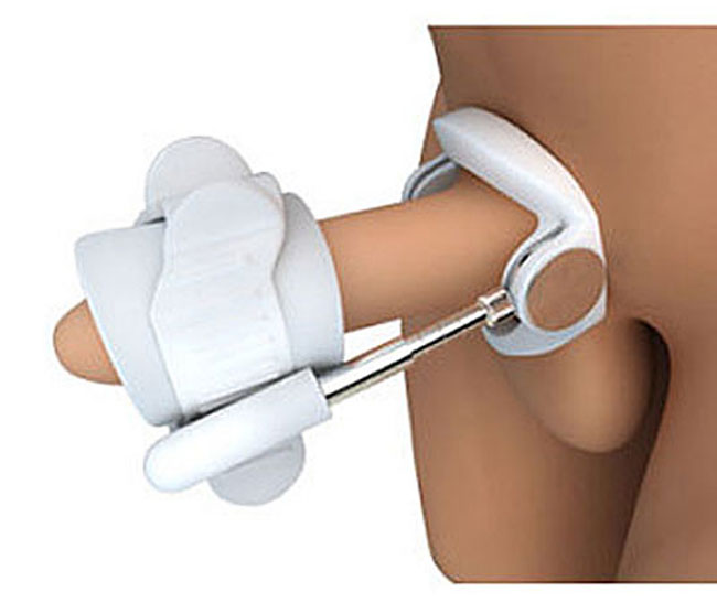 Wearing a penis traction device is comfortable, and Highly Effective for Peyronies Disease bent penis straightening.