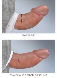 curved penis straightening with Xiaflex