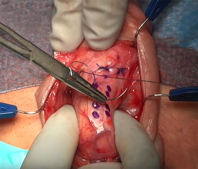 16 dot plication for peyronies disease