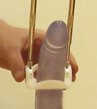 penis traction device used to fix a bent erection