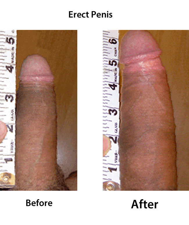 penis lengthening with a traction device