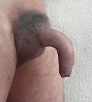 severe penis curvature, downward curved