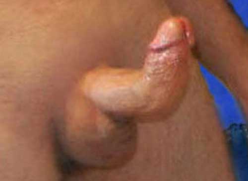 Natural peyronies disease treatment for a bent penis