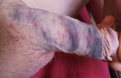 corporal rupture, fractured penis, broken penis