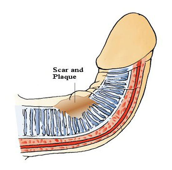 Peyronies disease scar and plaque