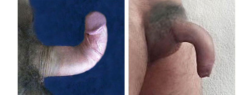 bent penis disease