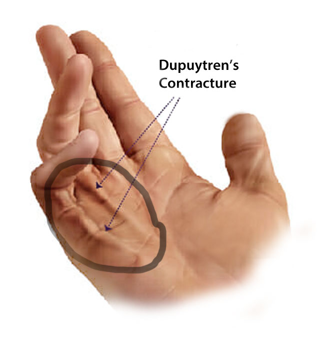 dupuytrens contracture and a bent penis