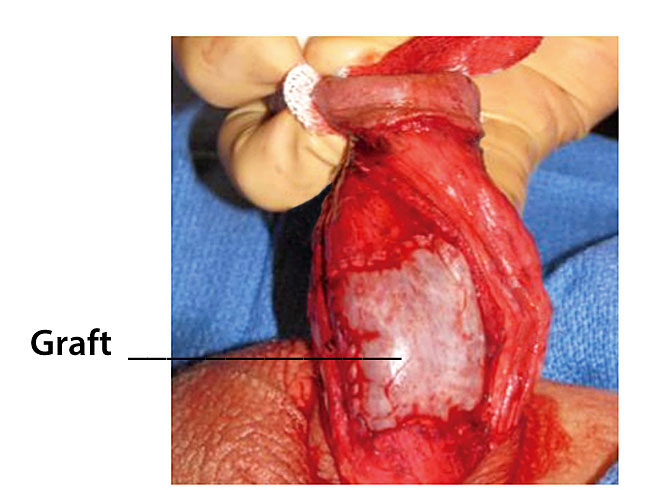 penis surgery, lengthen the shorter side with a graft