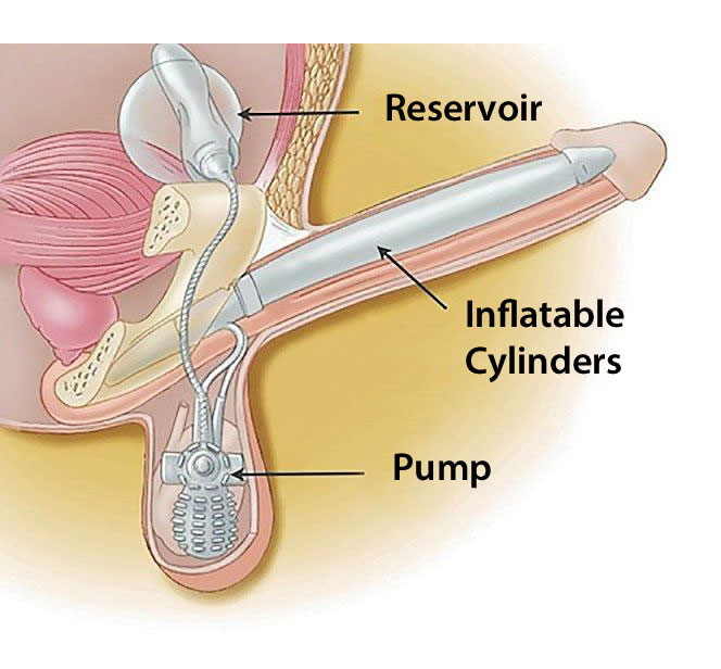 how a penile implant works