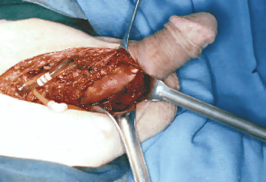 penis implant surgery