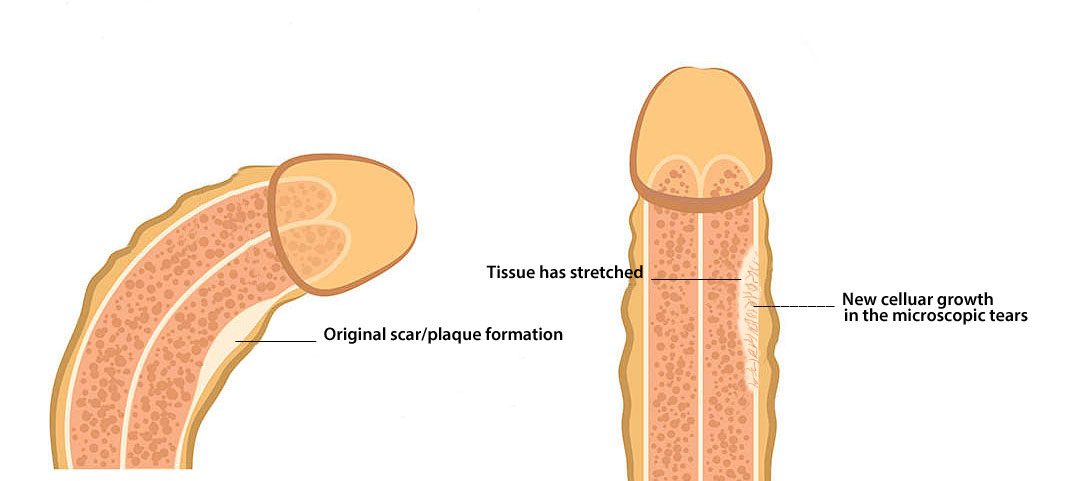 traction therapy for penis curvature