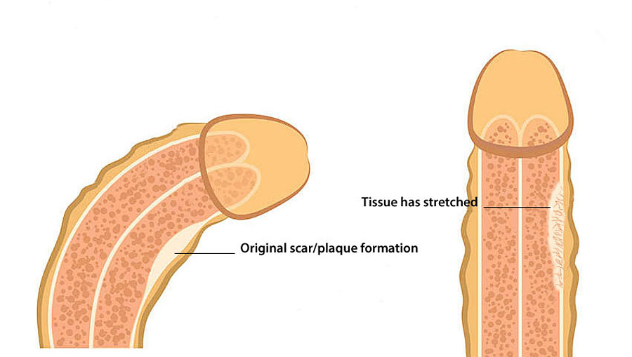 penis pain from penile bending