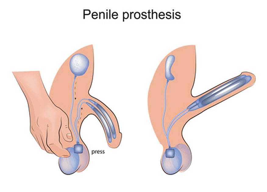 penile prosthesis for erectile dysfunction cure