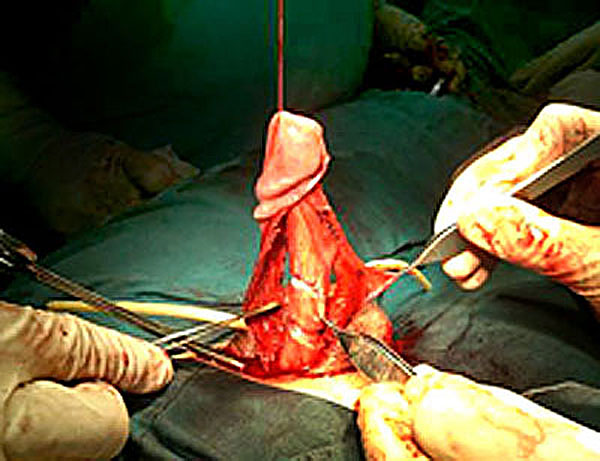 degloving for fractured broken penis surgery