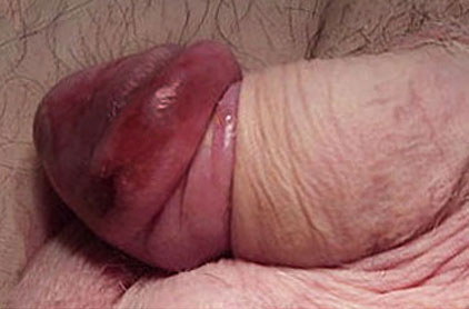 burst blood vessels in the tip of a penis