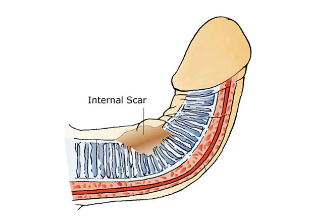 curved penis straightening