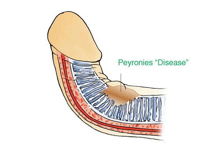 straighten a bent penis