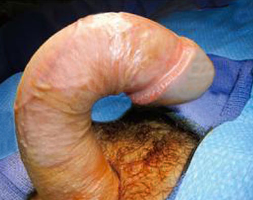 severe peyronies disease penile bending