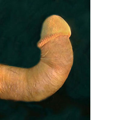 severe bent penis disease