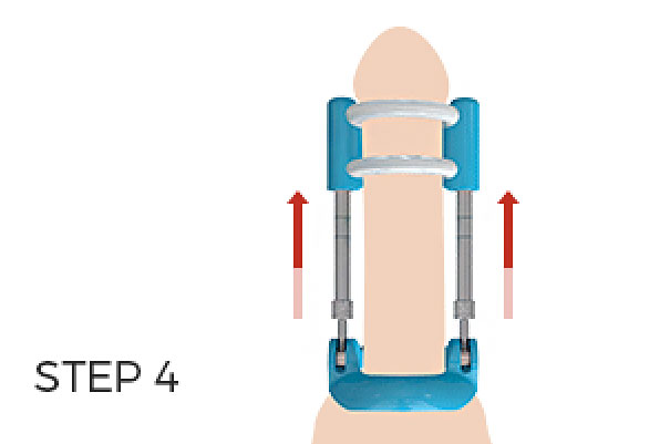 penis traction therapy #4