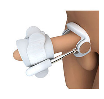 penis traction therapy treatment for penile curvature